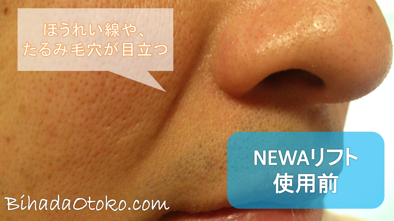 NEWAリフトの口コミ・効果・最安値！専門家が男の肌で検証実験！ikko